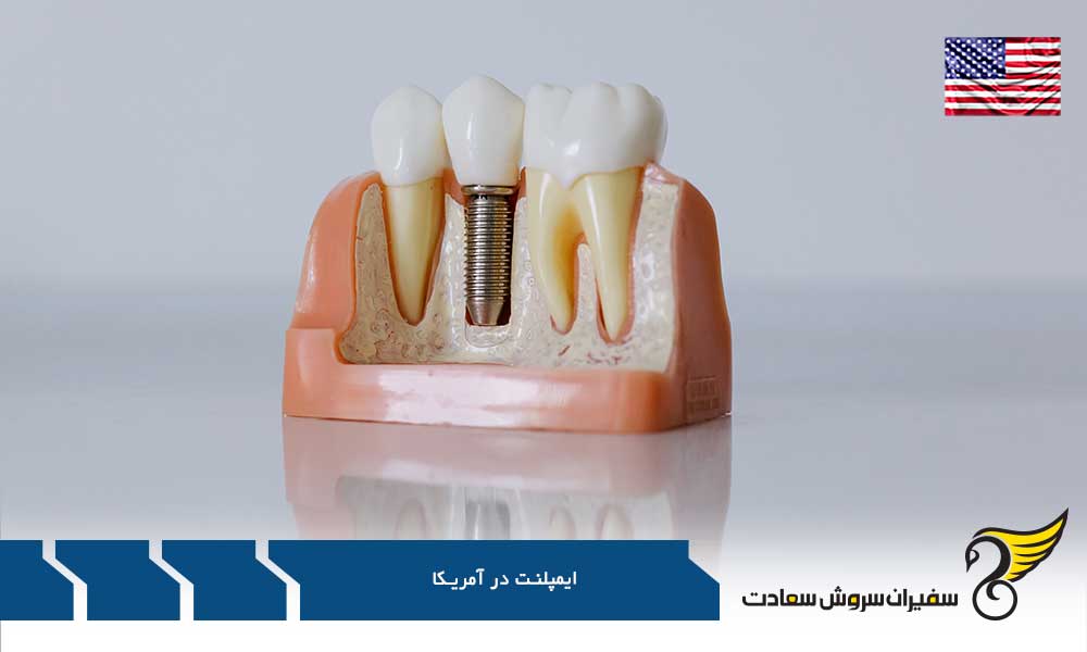 شرایط پذیرش برای تحصیل ایمپلنت در آمریکا